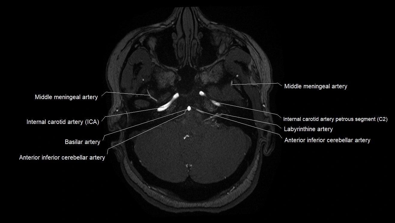 MRA brain (cerebral arteries) anatomy axial 3T image 1.webp